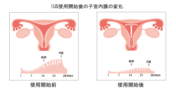 子宮内避妊具 ミレーナ ゆかりレディースクリニック 神戸市三宮にある婦人科