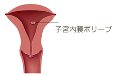 子宮 内 膜 掻爬