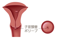 子宮 頚 管 ポリープ 切除
